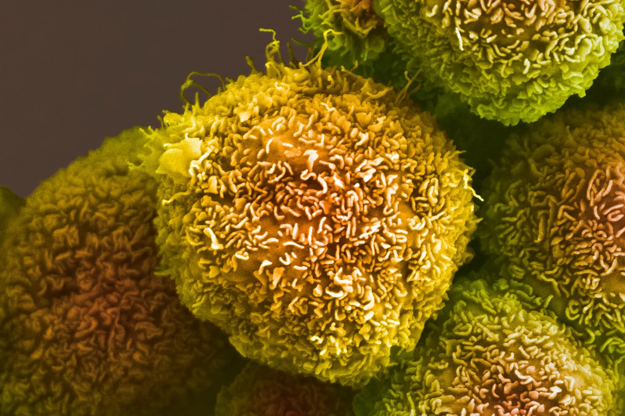 Lustgarten-funded clinical trial yields promising results as the Journal Nature publishes findings: Personalized RNA neoantigen vaccines stimulate T cells in pancreatic cancer.
